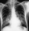 Hémorragie alvéolaire (syndrome de Goodpasture)