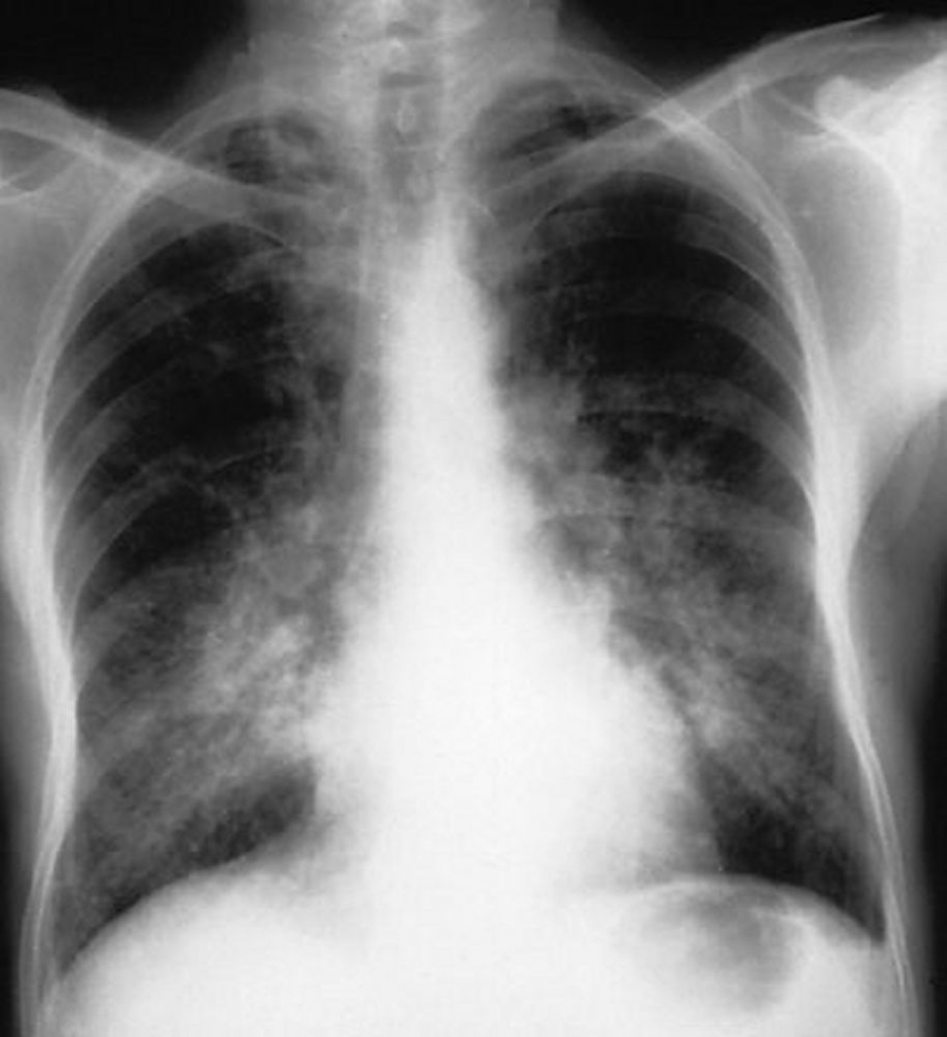 Hémorragie alvéolaire (syndrome de Goodpasture)