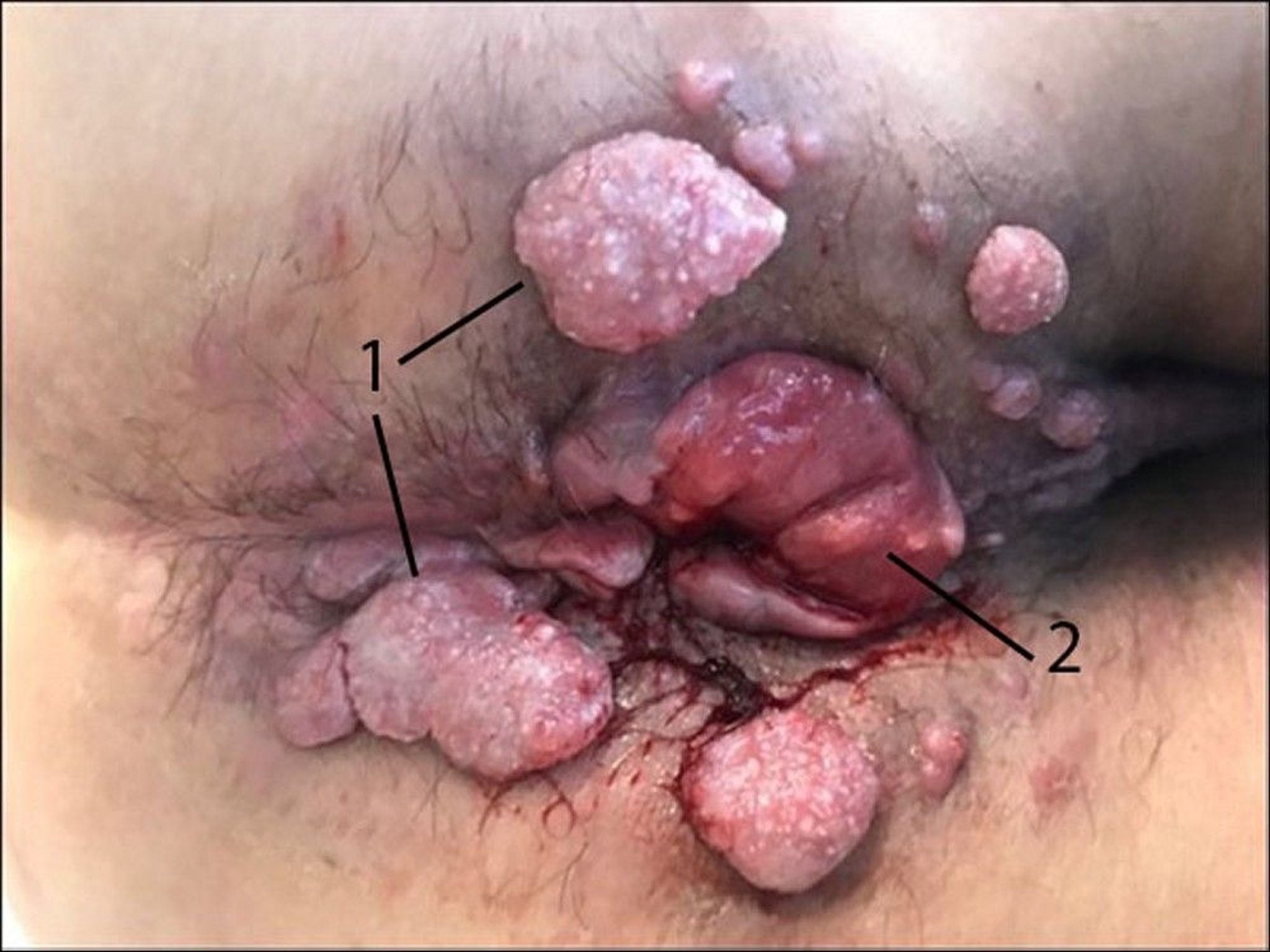 Anal Carcinoma