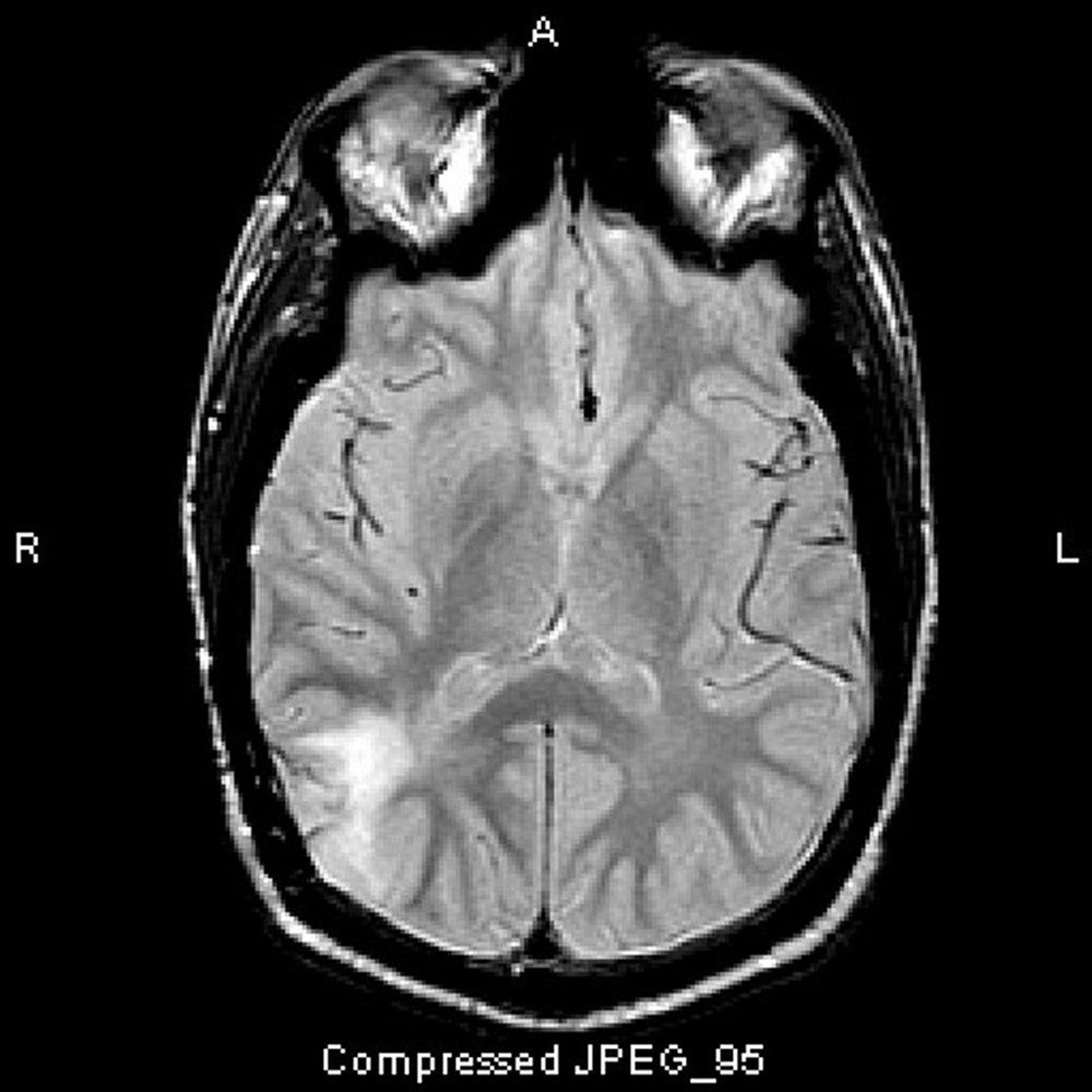 Anaplastic Astrocytoma