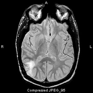 Astrocitoma anaplastico