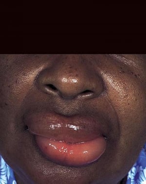 遺伝性血管性浮腫