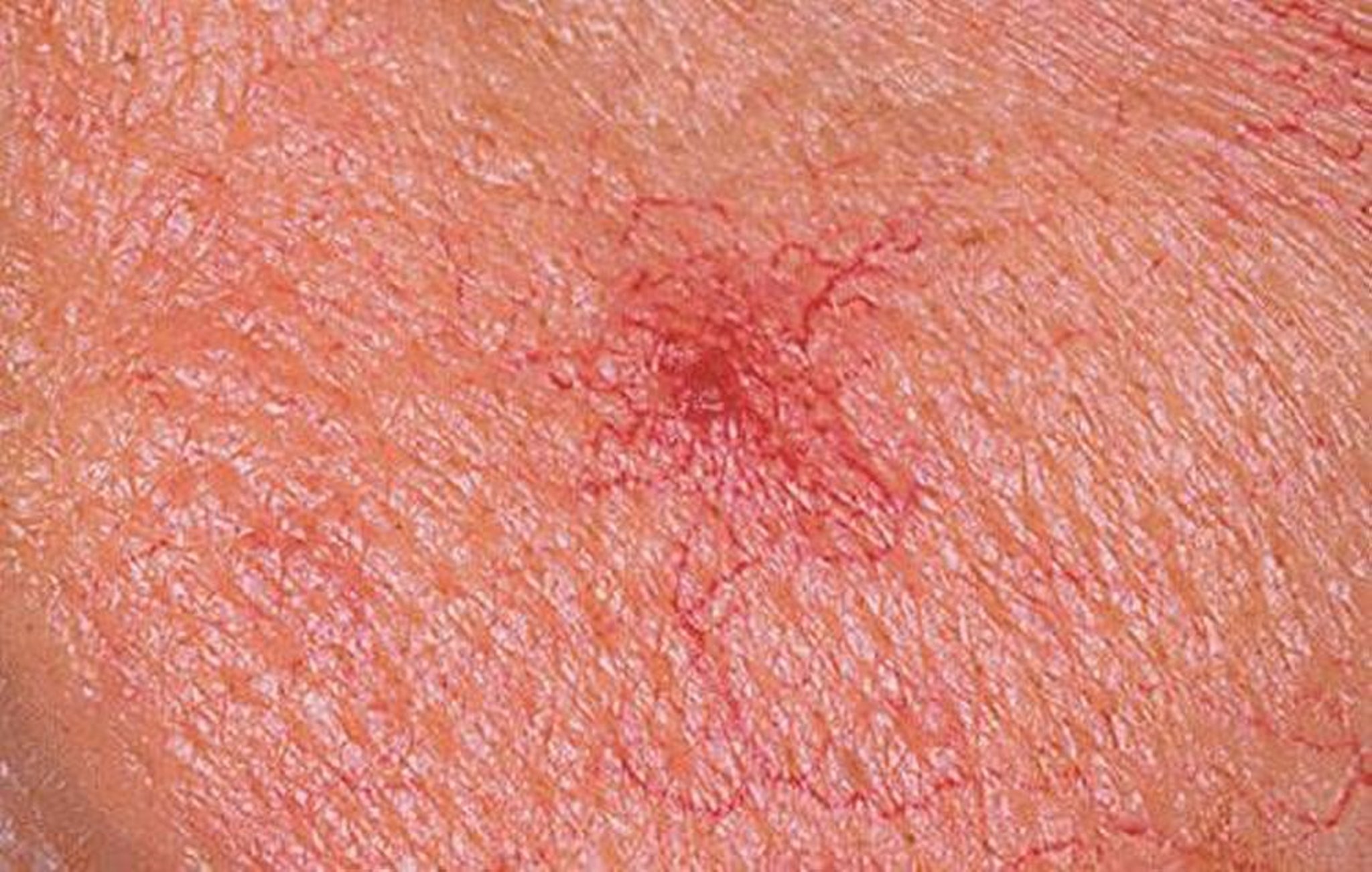 Angioma en araña (aracniforme o araña vascular)