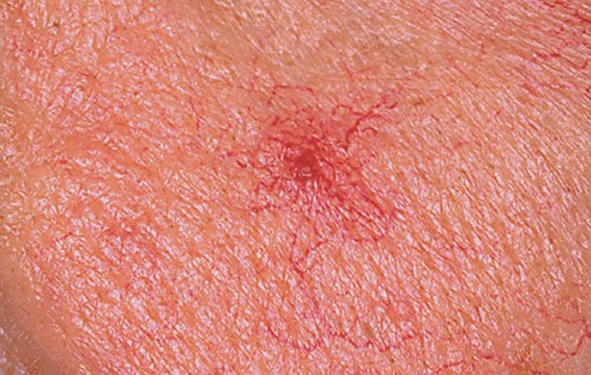 Паукообразная гемангиома