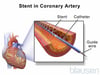 Angioplastia con prótesis endovascular (stent)