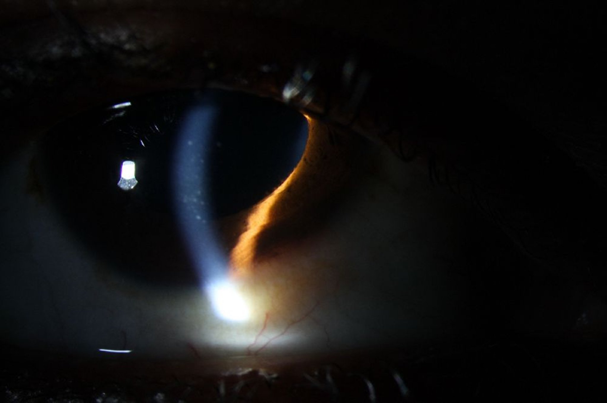 Uveítis (anterior)