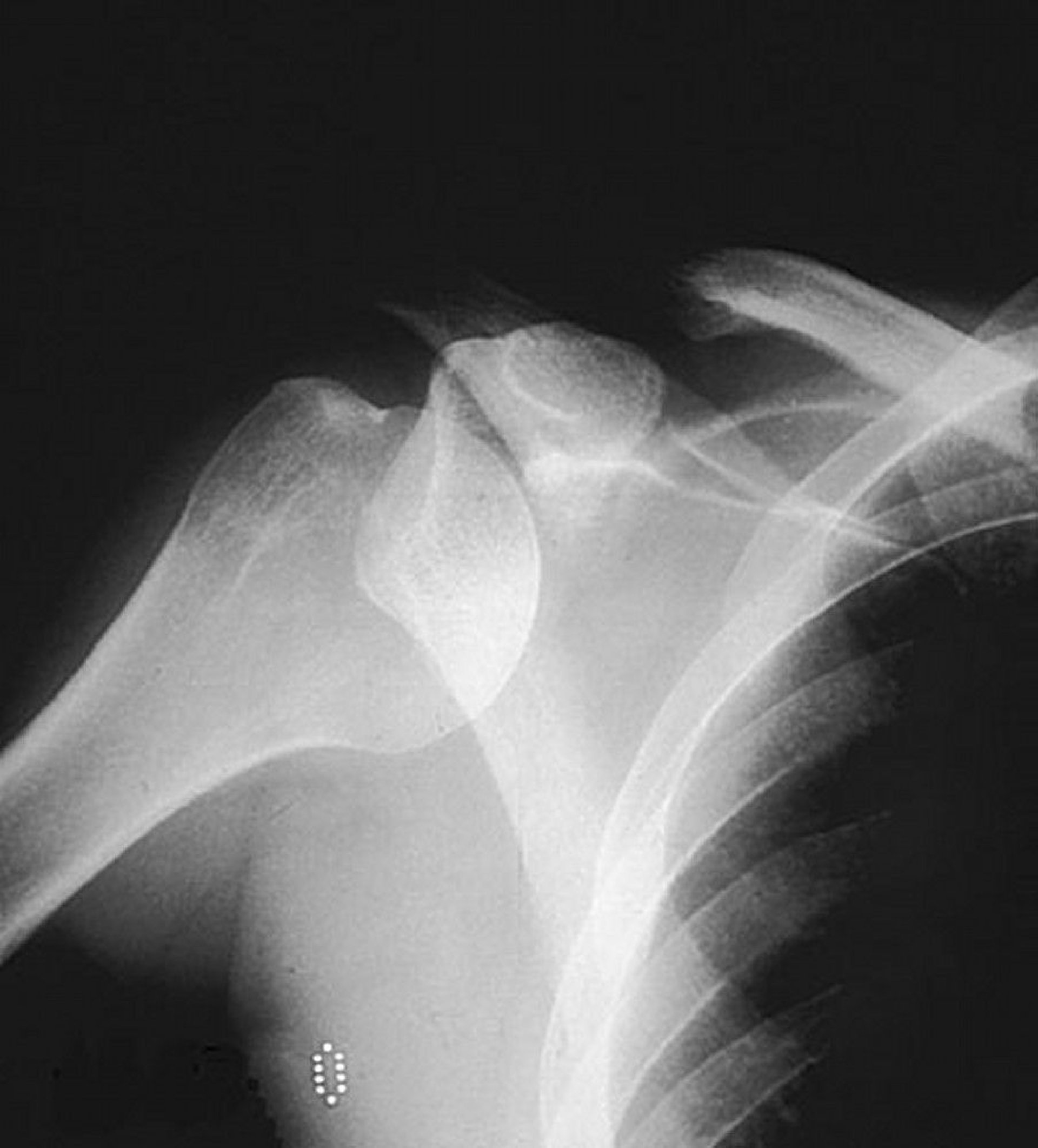 Anterior Glenohumeral (Shoulder) Dislocation