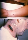 Anthrax (Cutaneous)