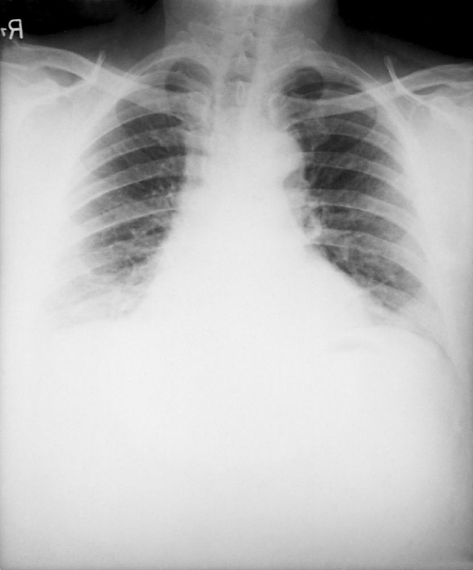 Carbunco (inhalación)