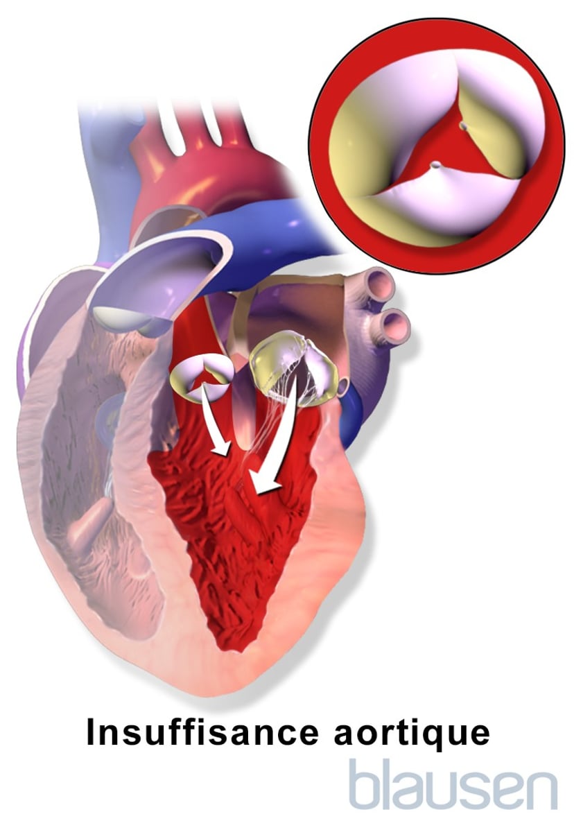 Souffle Aortique Sympt mes Souffle Cardiaque Causes Principales PBCYJ Souffle Aortique Sympt mes Souffle Cardiaque Causes Principales PBCYJ