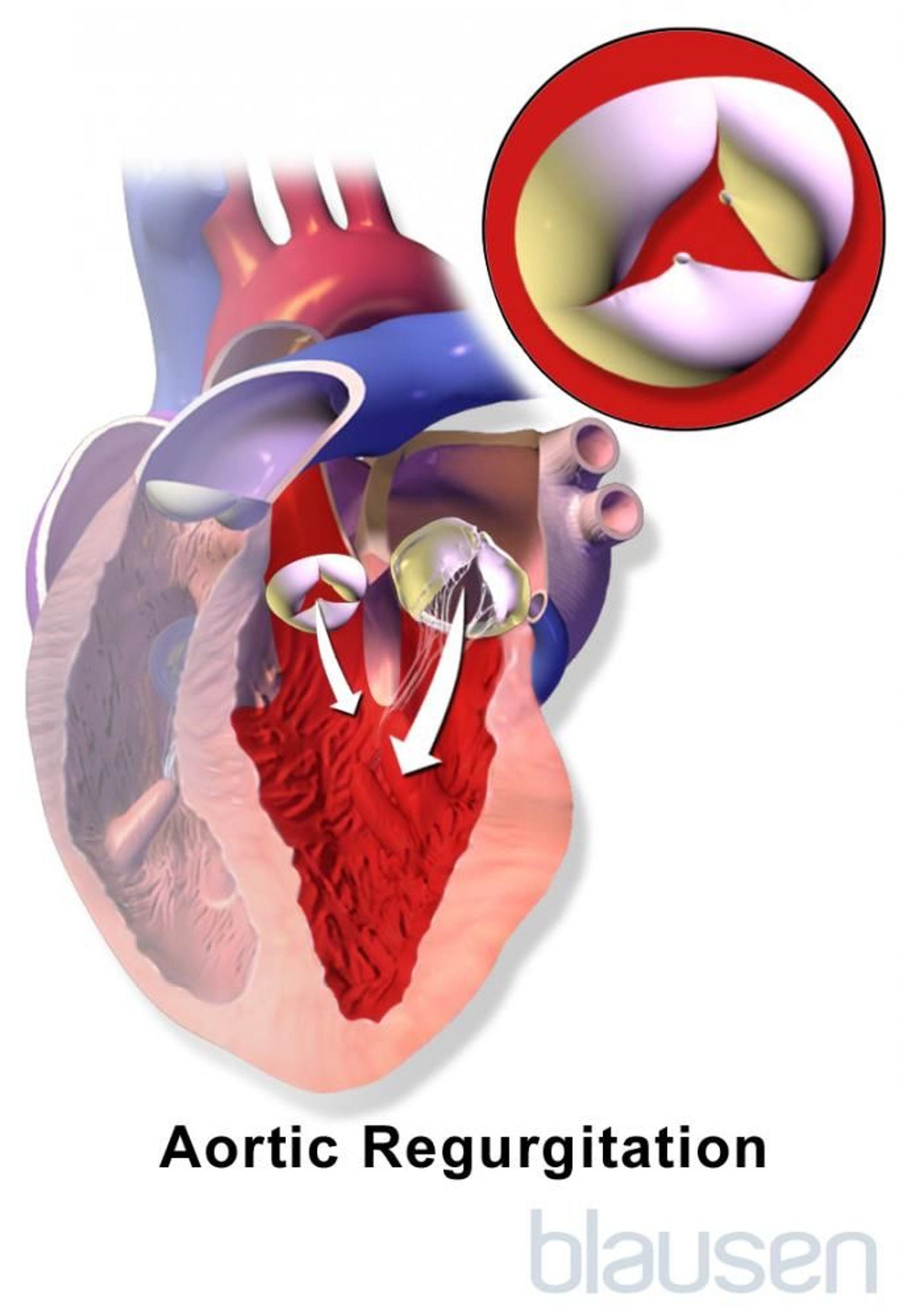 Insufficienza aortica