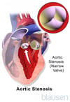 Stenosi aortica