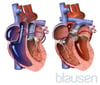 Switch arterioso