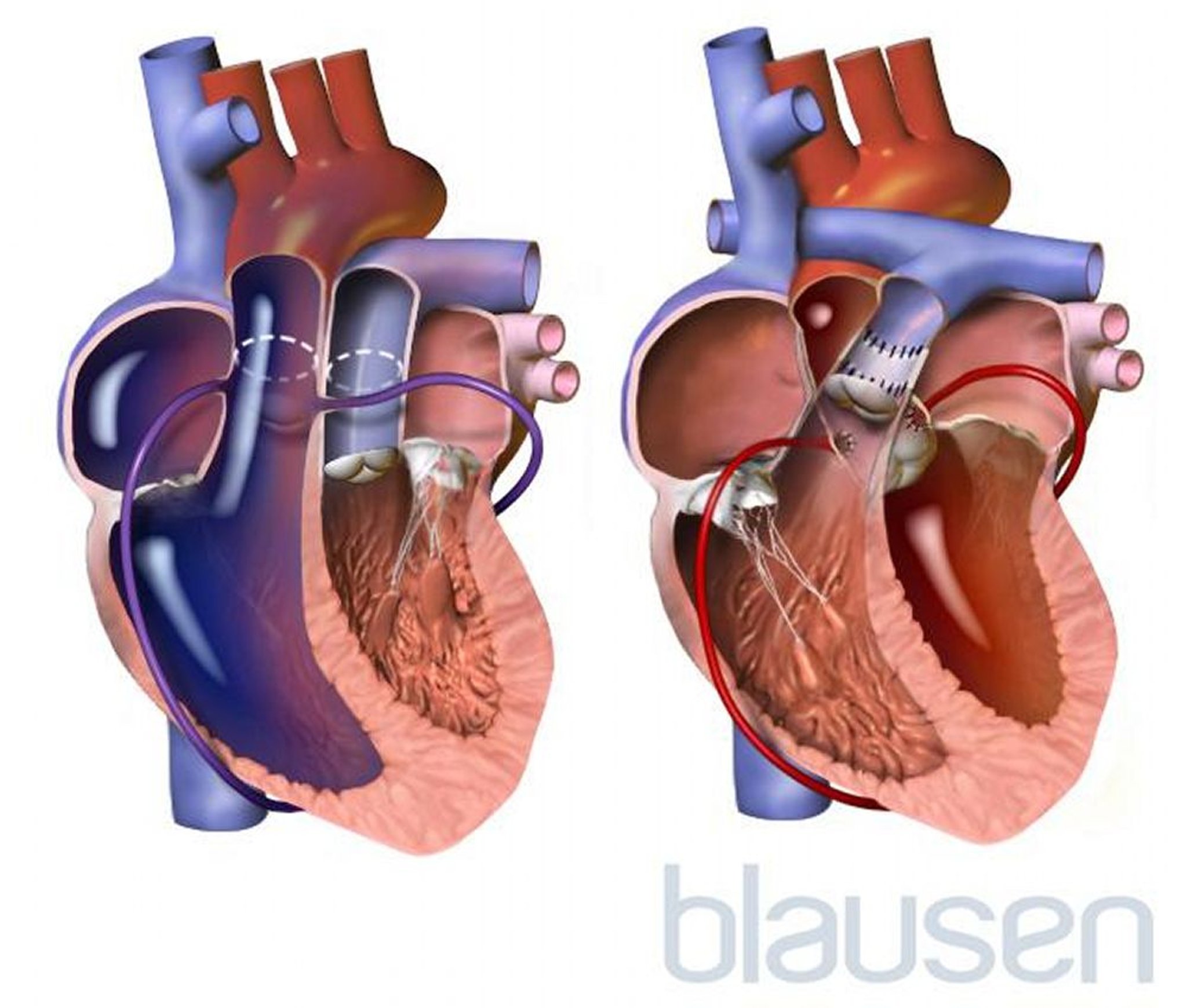 動脈スイッチ手術