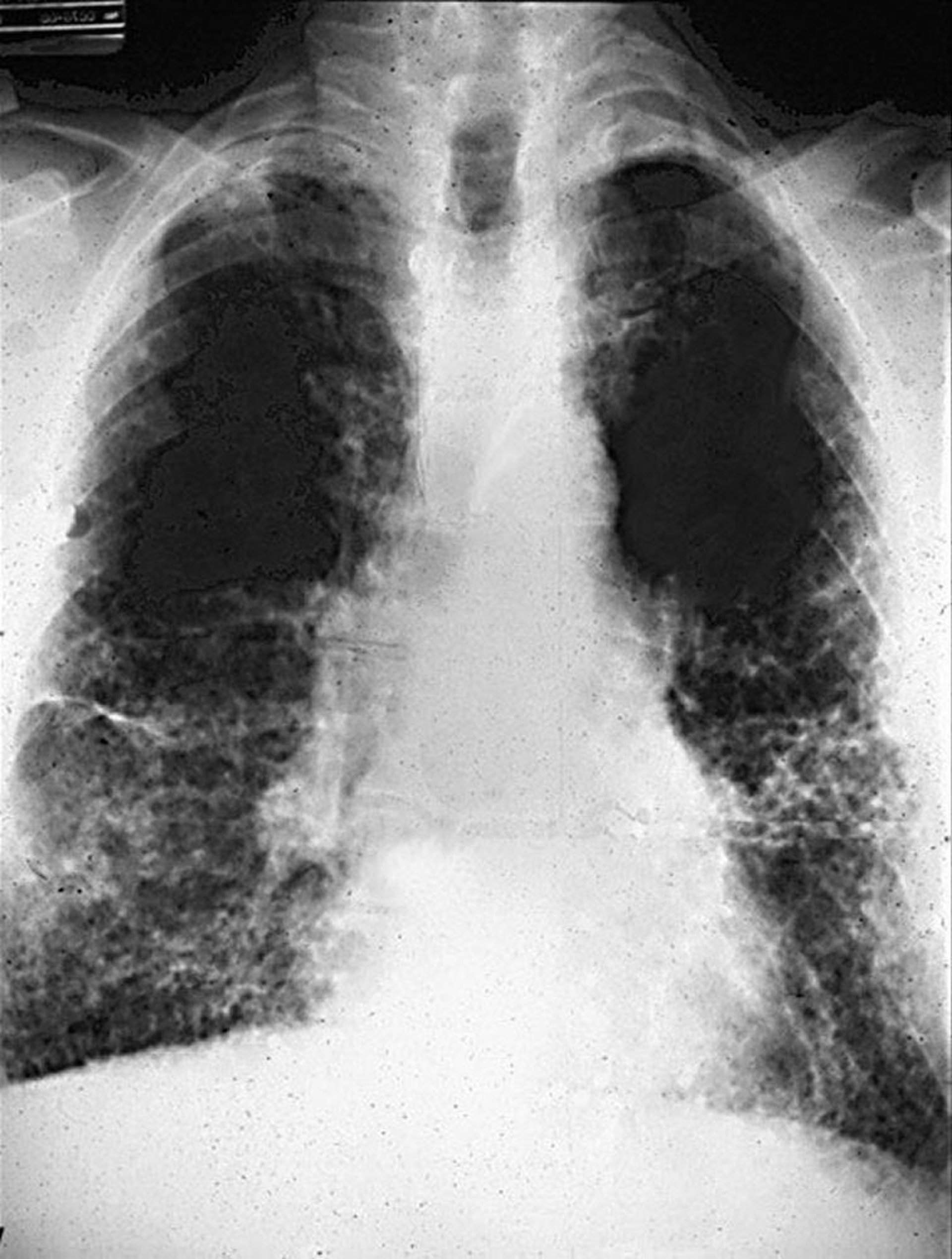 Bệnh bụi phổi amiăng