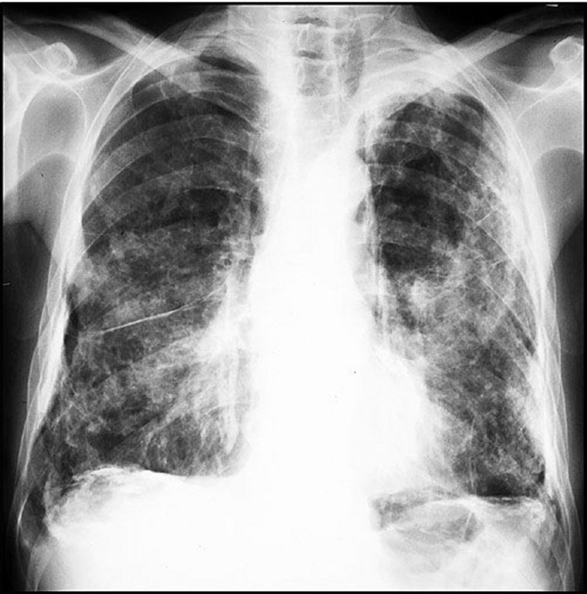 Asbestos-Related Plaques (Extensive)