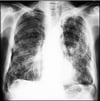 Asbestbezogene Plaques (umfangreich)