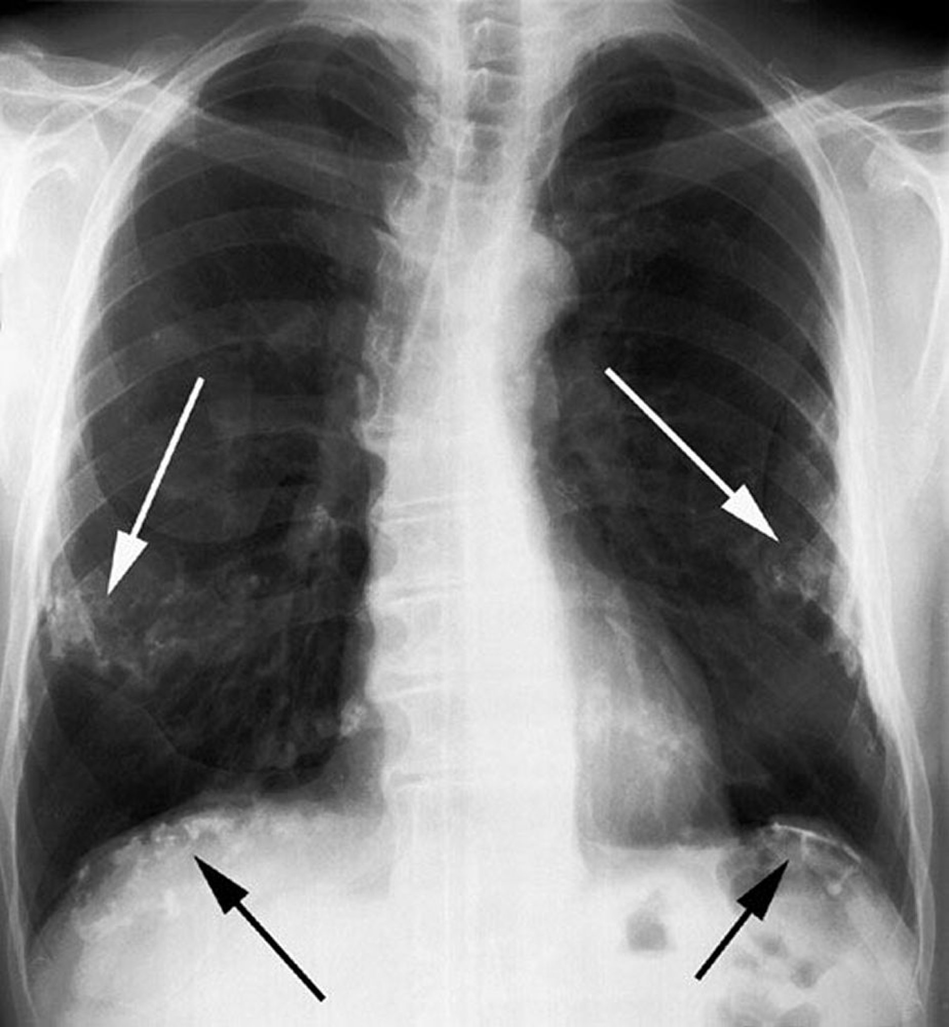 Asbestbedingte Plaques