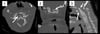 Subluxación atlantoaxial (TC)