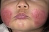 Atopic Dermatitis (Acute)