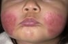 Dermatitis atópica (aguda)