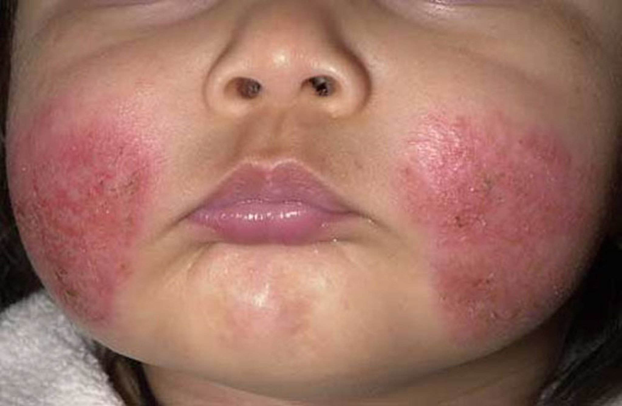 Dermatitis atópica (aguda)