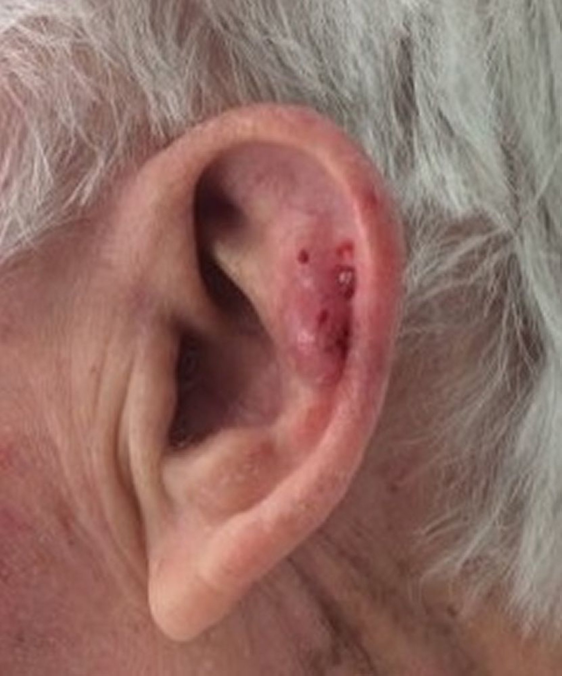 Fibroxanthome atypique sur l'oreille