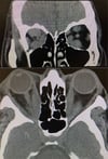 Thyroid Eye Disease (CT Scans)