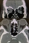 Enfermedad tiroidea ocular (TC)