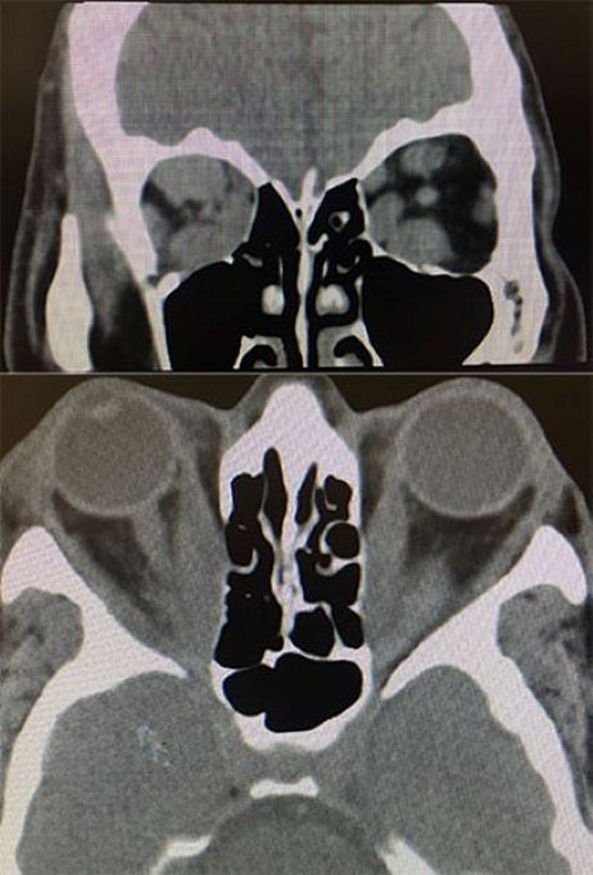 Doença ocular da tireoide (TC)