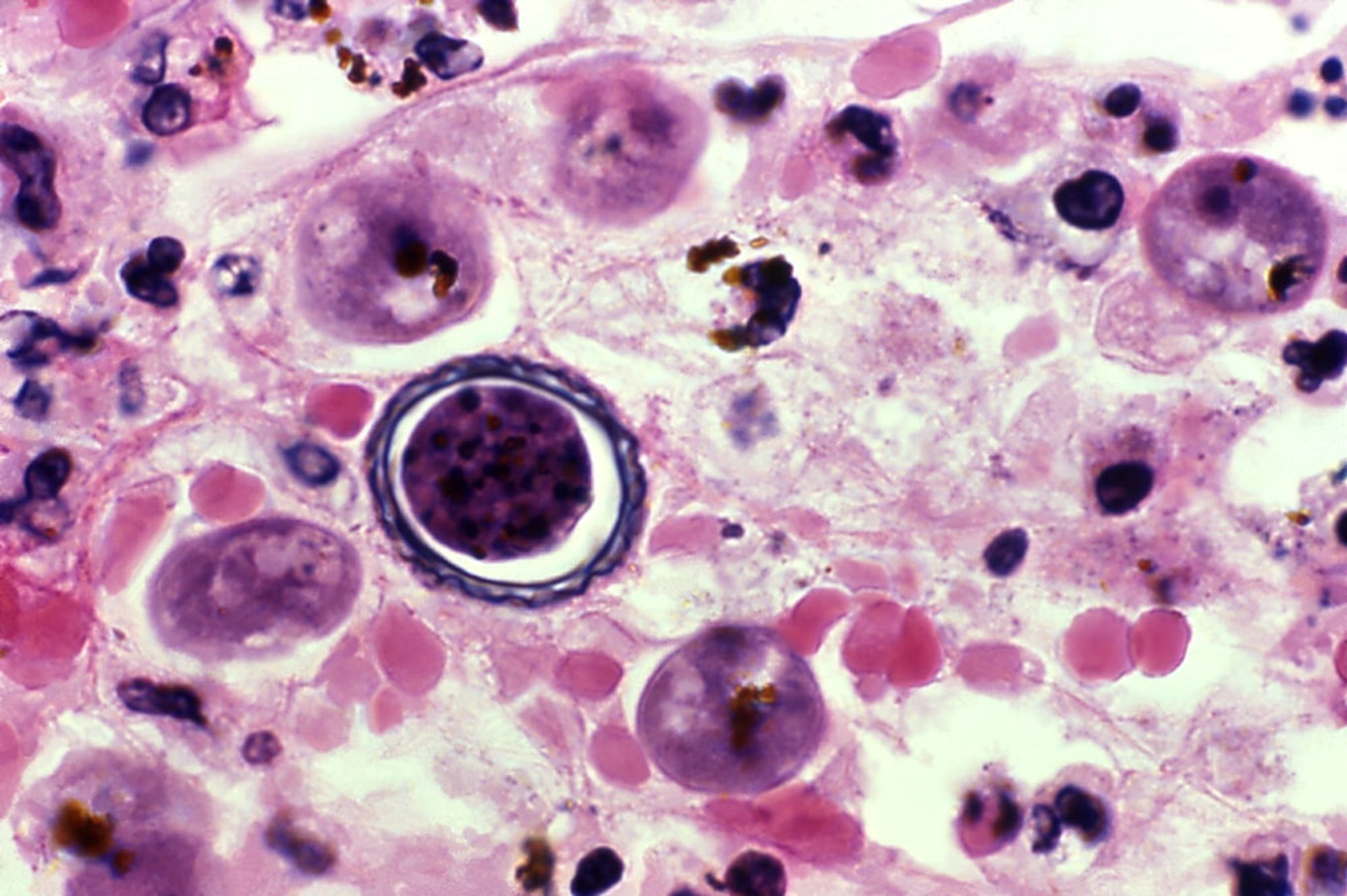 <i >Acanthamoeba</i> Cyst in Brain Tissue