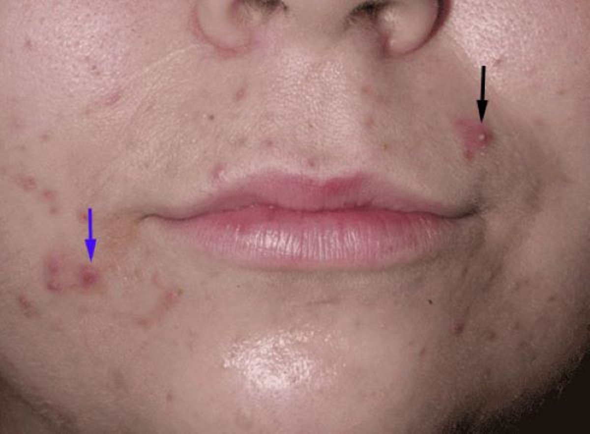 Acne (pápulas e pústulas)