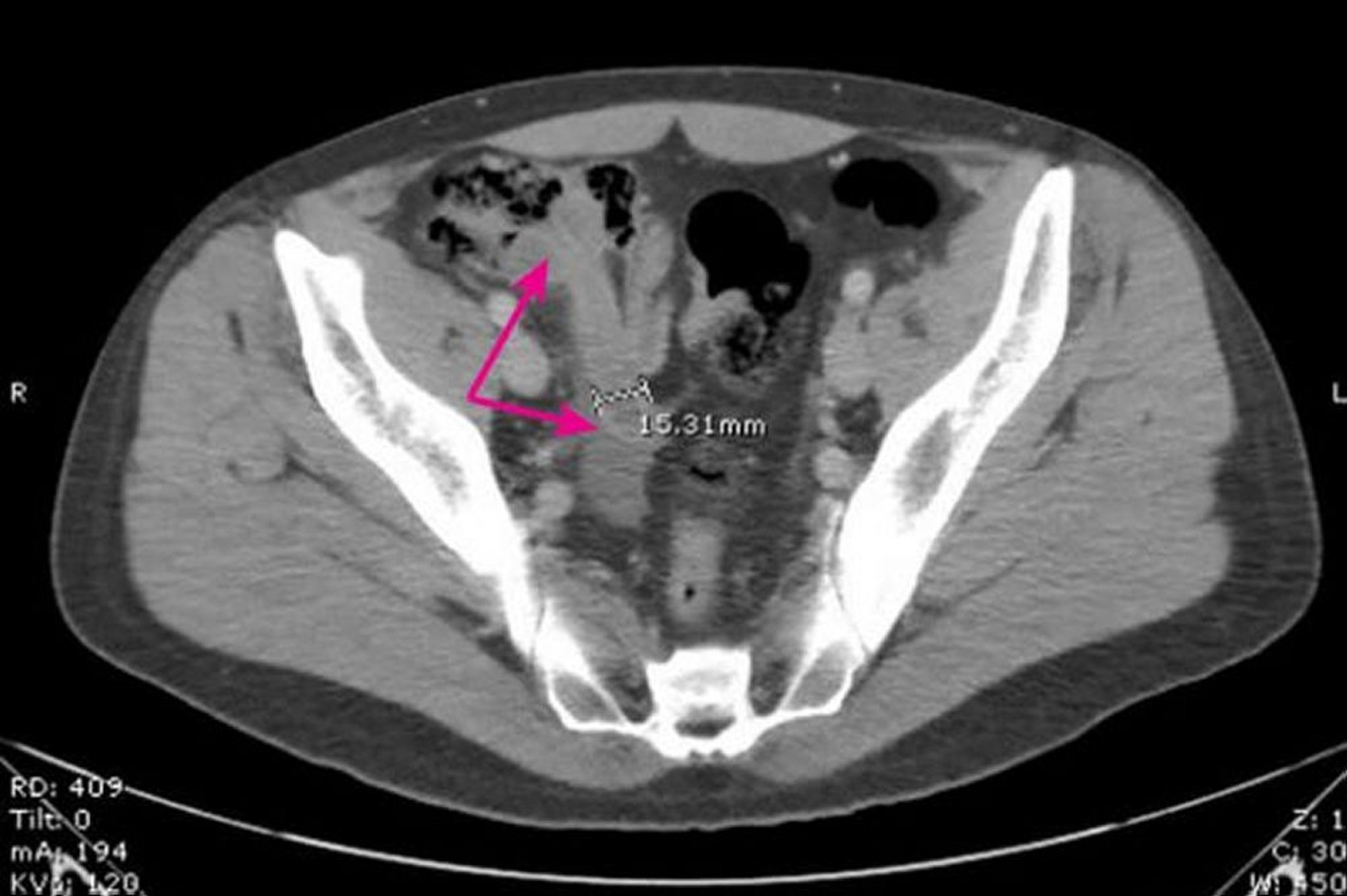 Acute Appendicitis