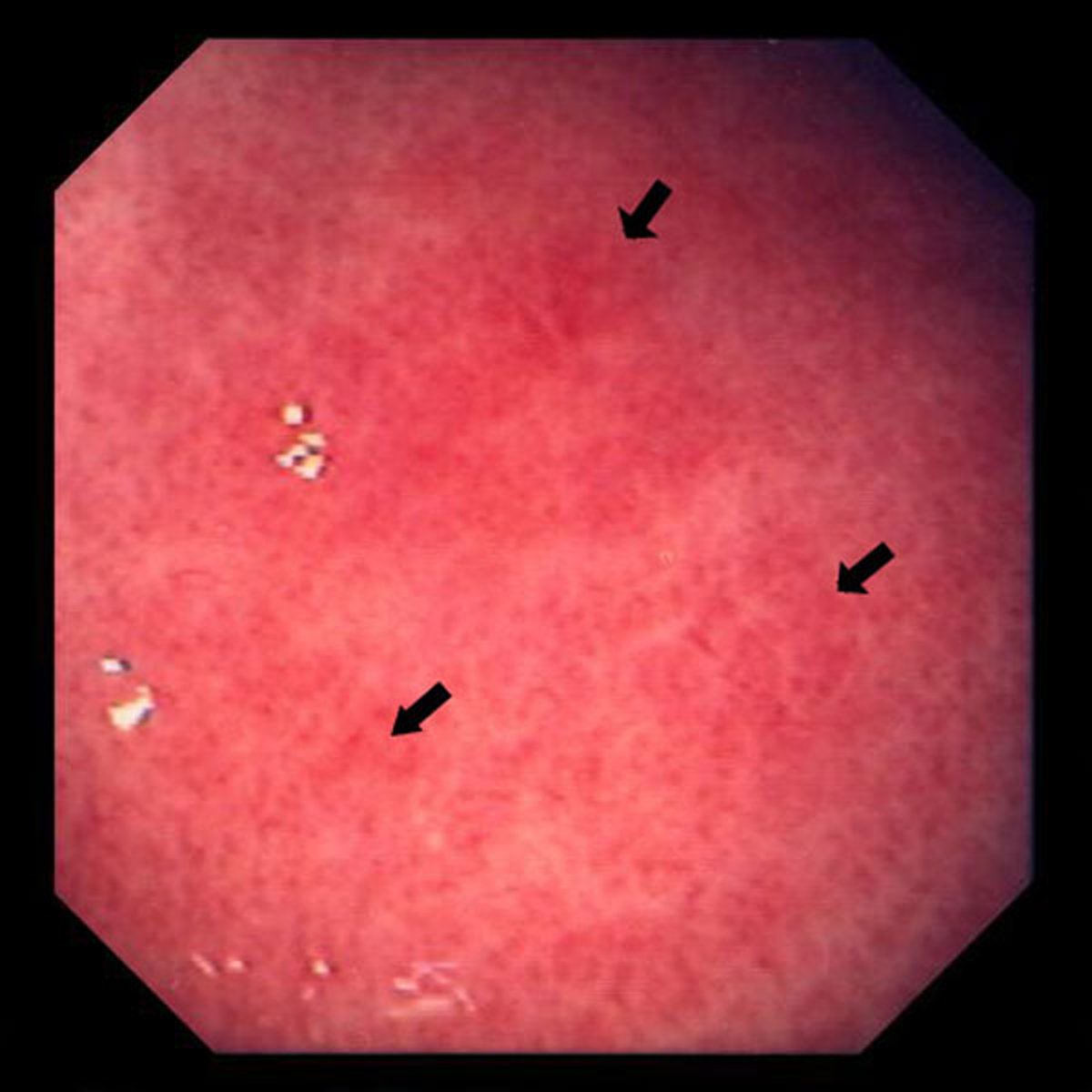 Gastritis aguda