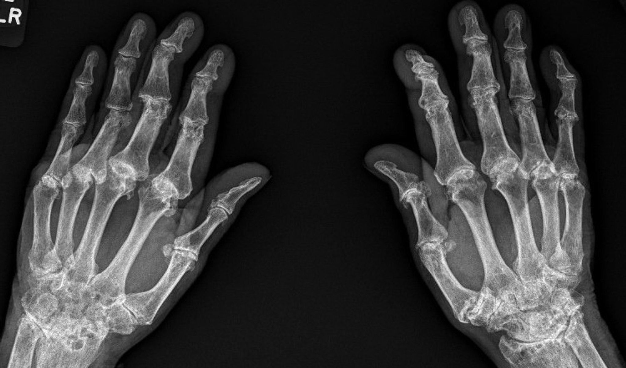 Các đặc điểm trên X-quang của viêm khớp dạng thấp do tiêu xương giai đoạn tiến triển