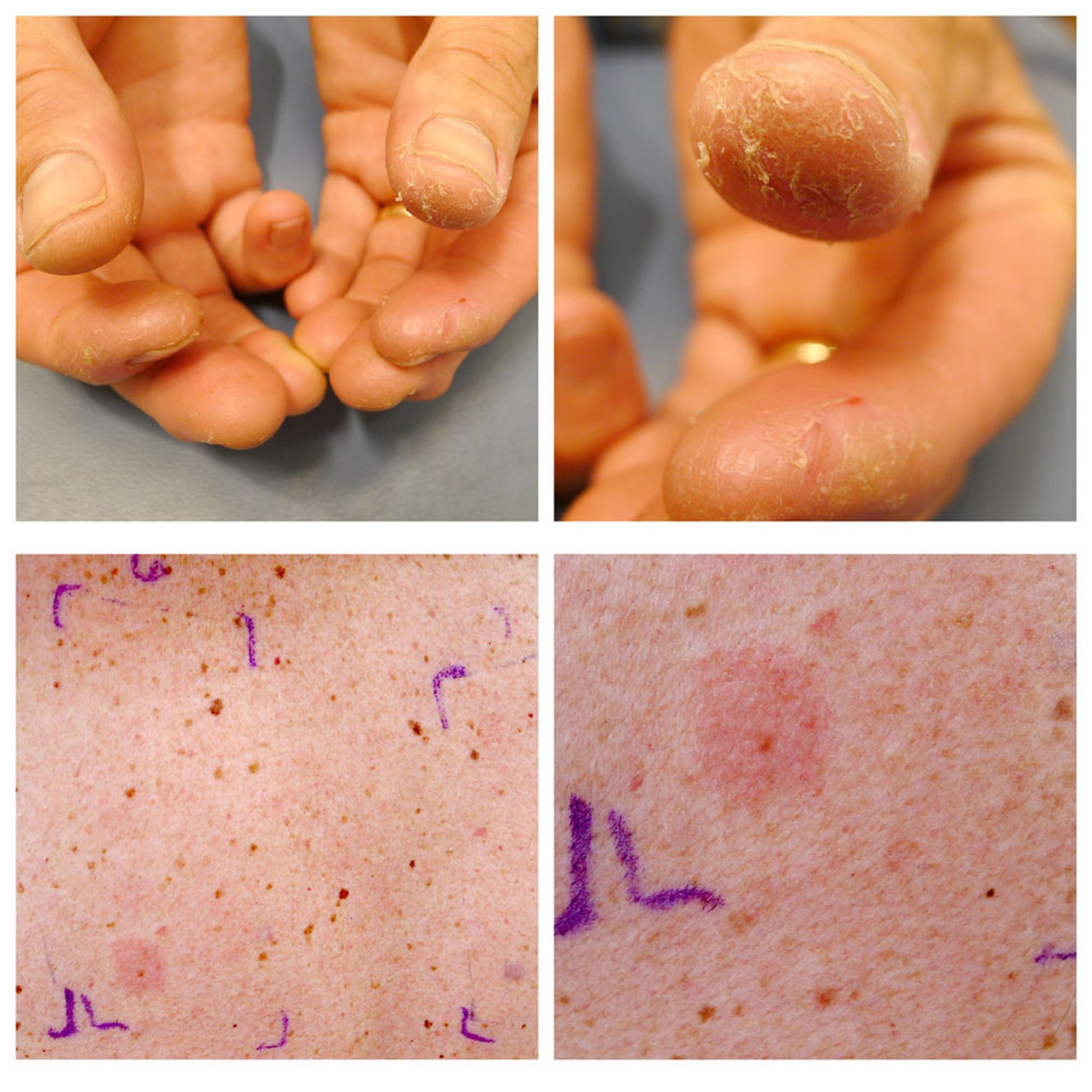 Patch Testing in Allergic Contact Dermatitis