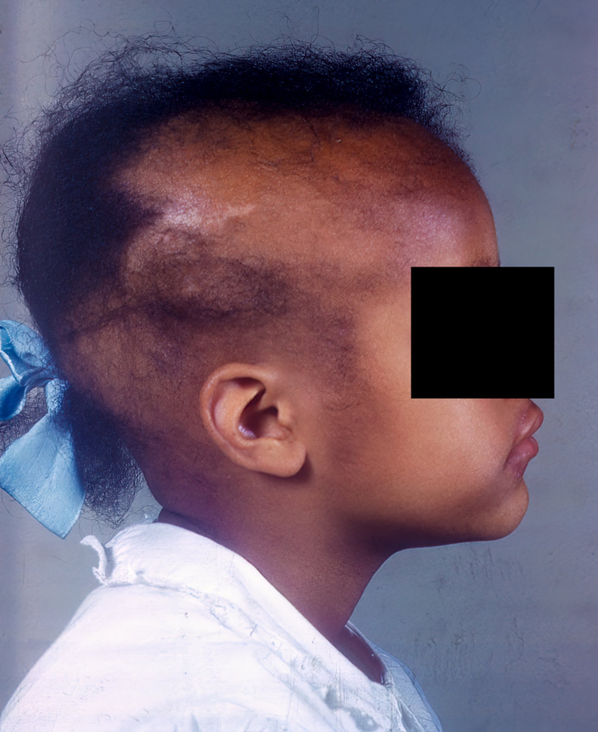 Alopecia areata (outra visão)