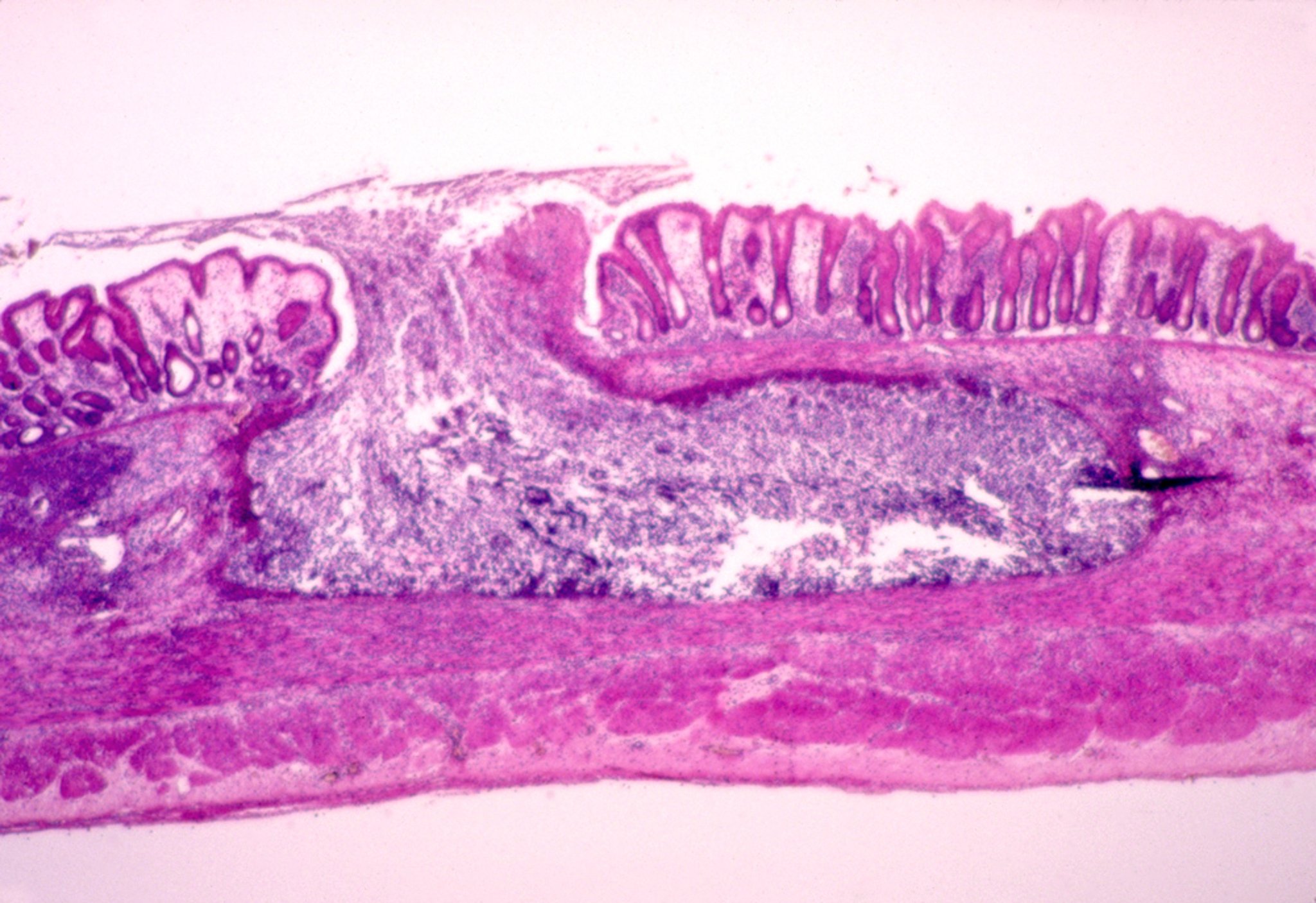 Flask-Shaped Ulcer of Amebiasis