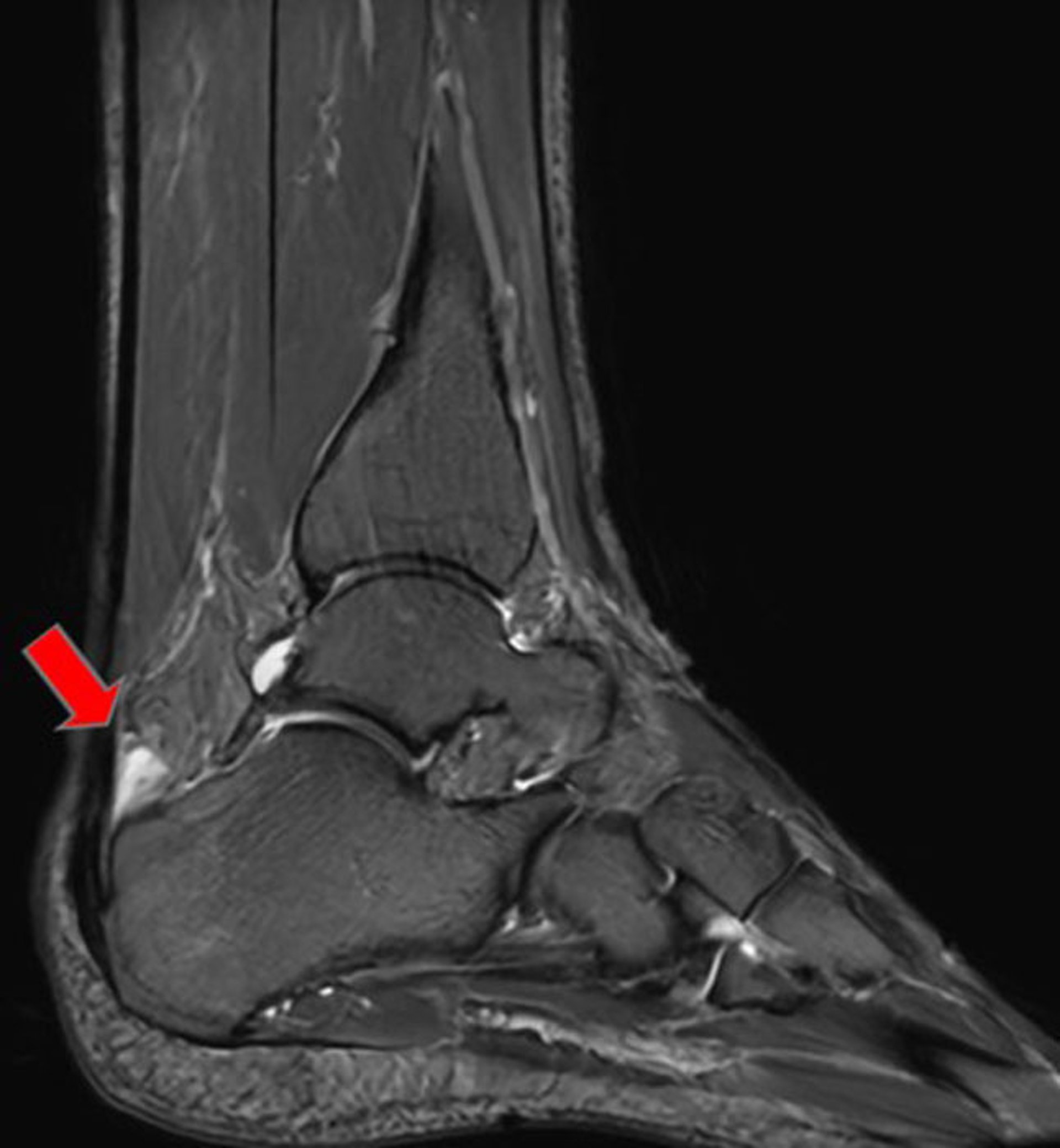 Anterior Achilles Tendon Bursa