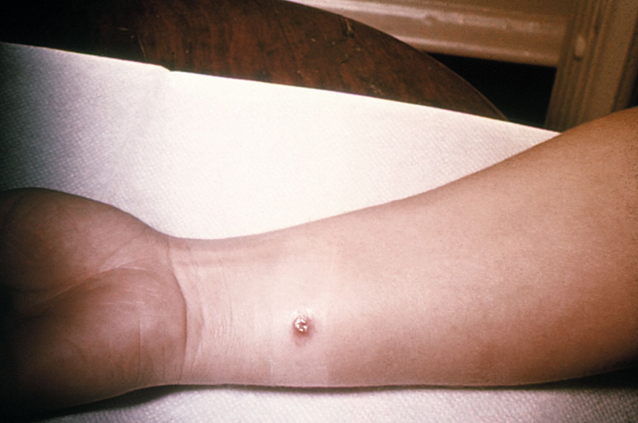 Cutaneous Anthrax (Early Lesion)