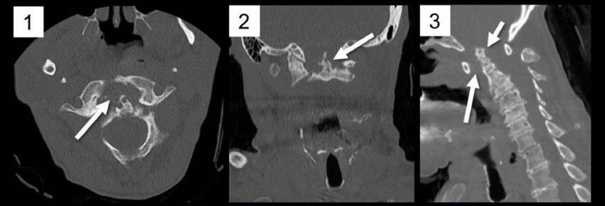 Atlantoaxiale Subluxation (CT)