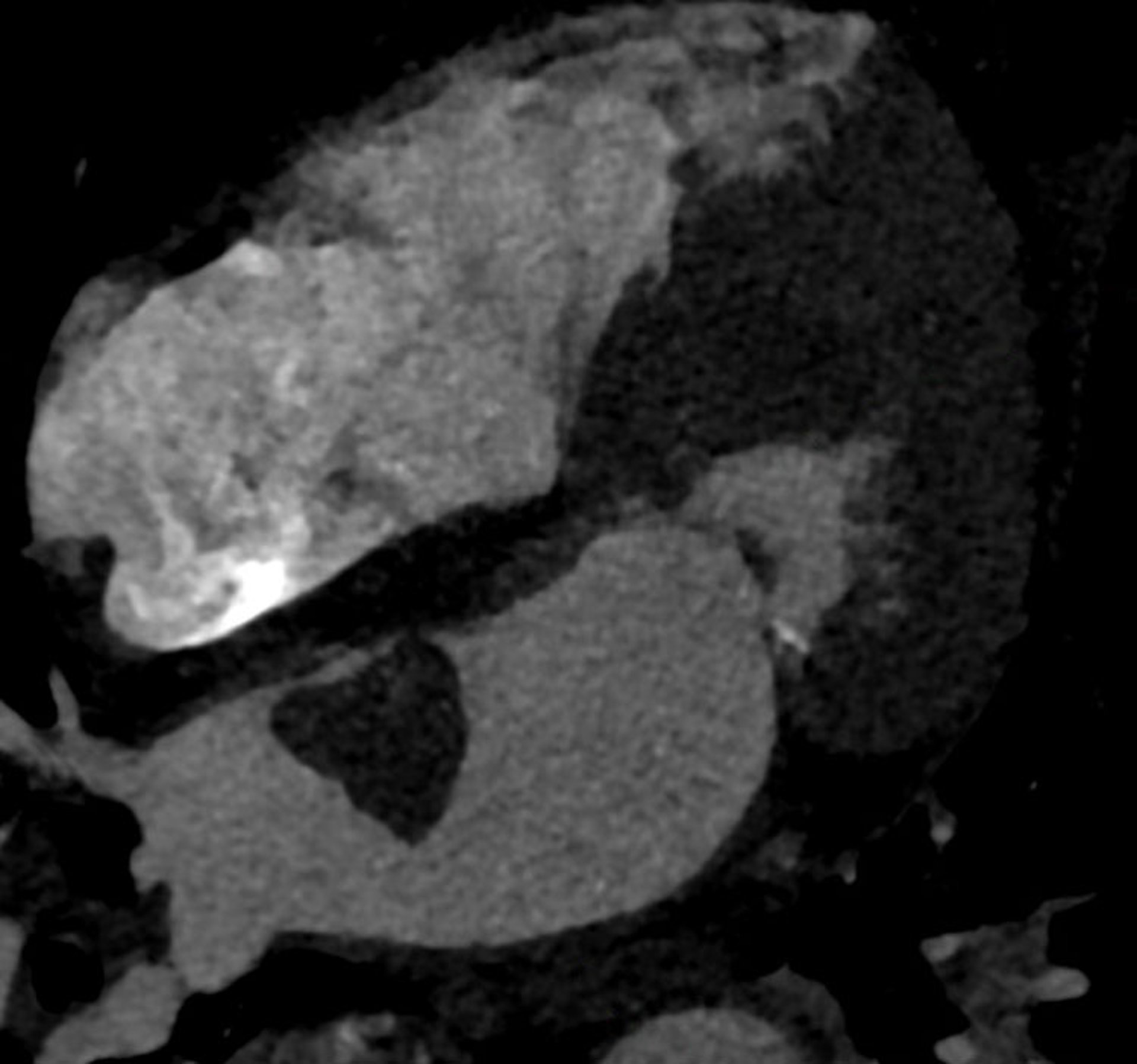 Atrial Myxoma (Cardiac CT)