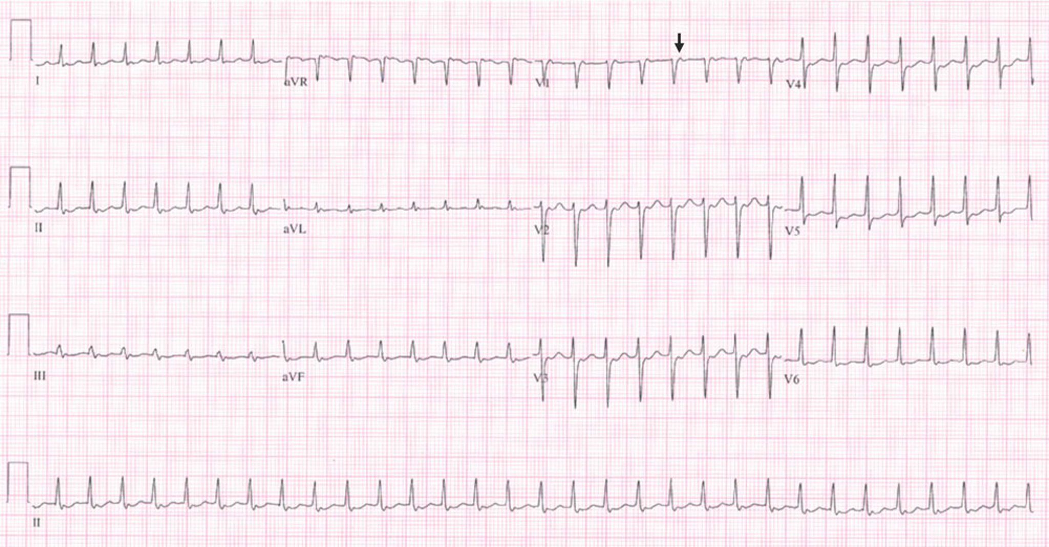 EKG der atrioventrikulären nodalen Reentry-Tachykardie (AVNRT)