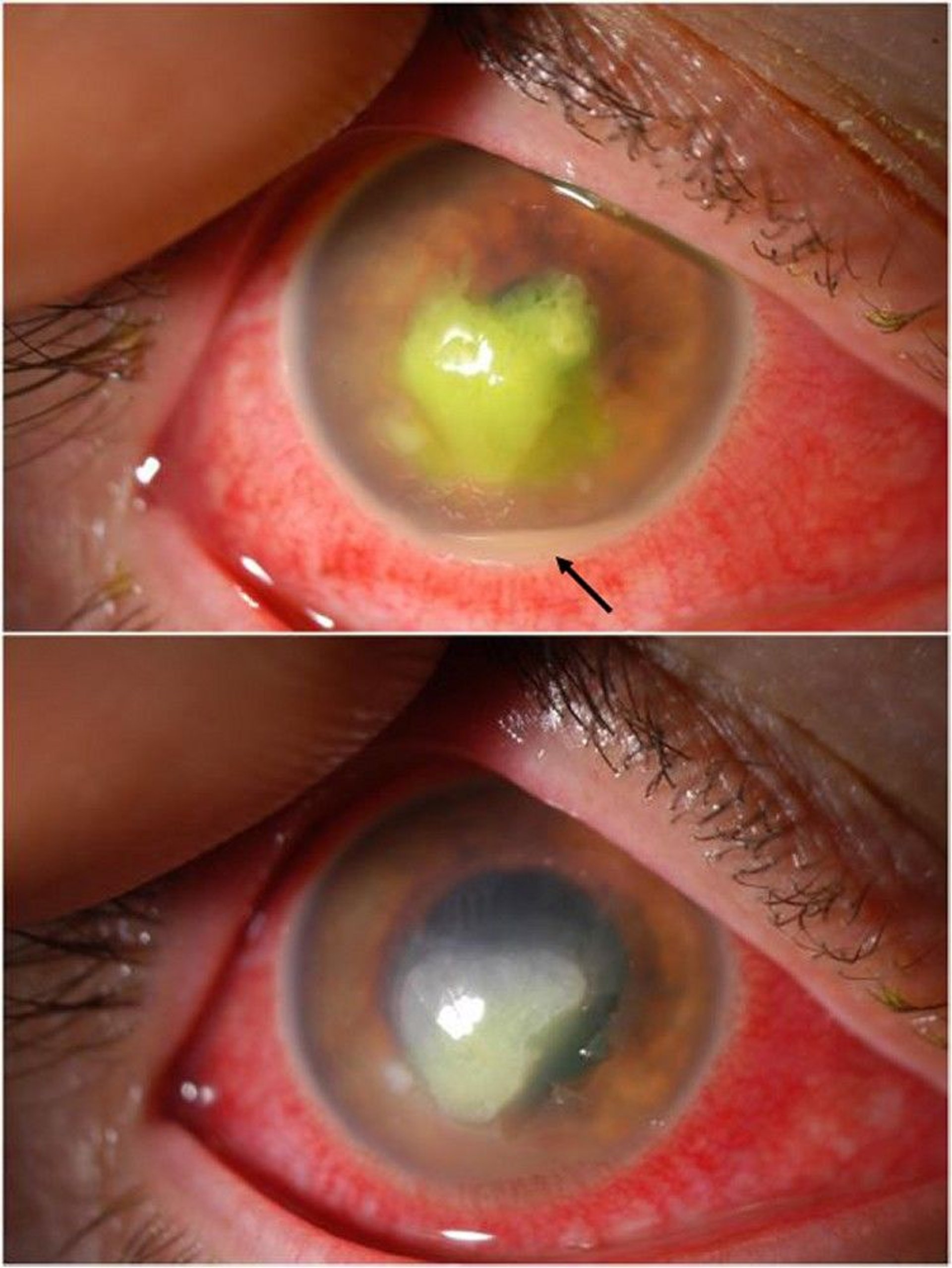 Corneal Ulcer