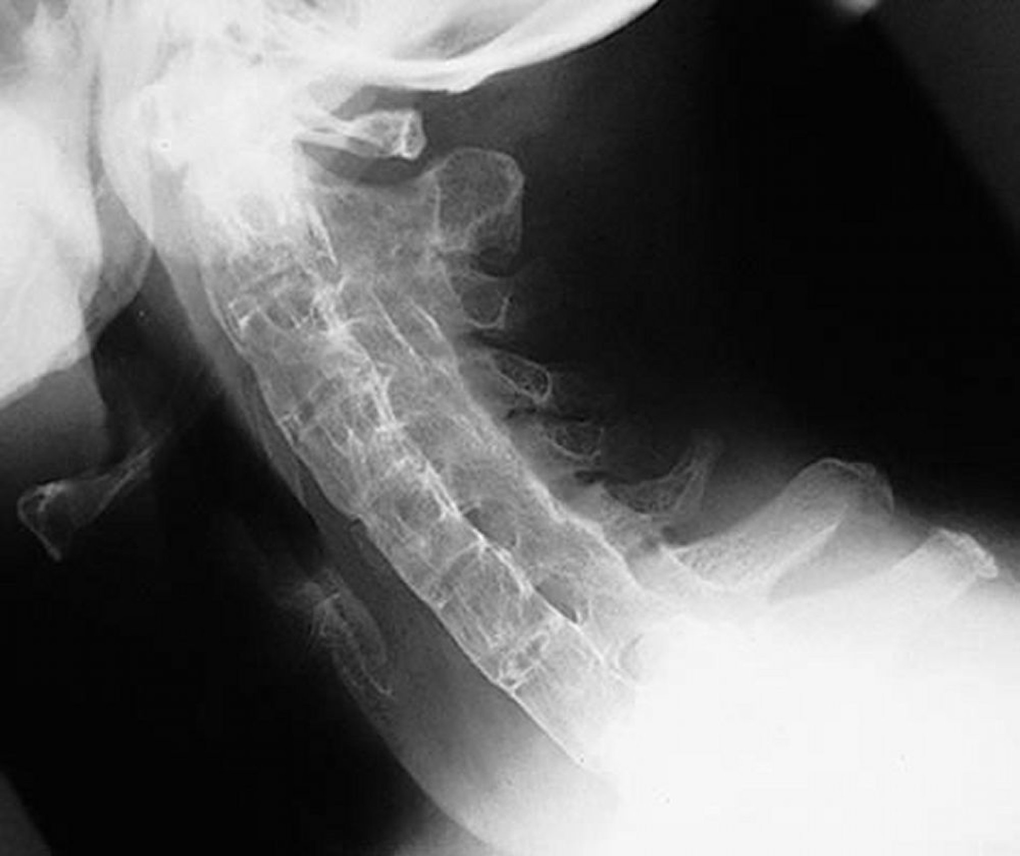 Colonna vertebrale a bambù nella spondilite anchilosante