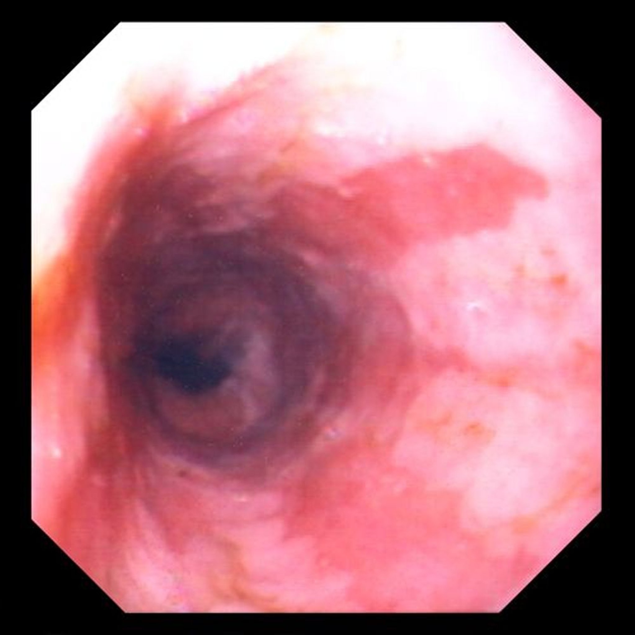 Barrett Esophagus