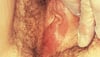 Bartholin Cyst