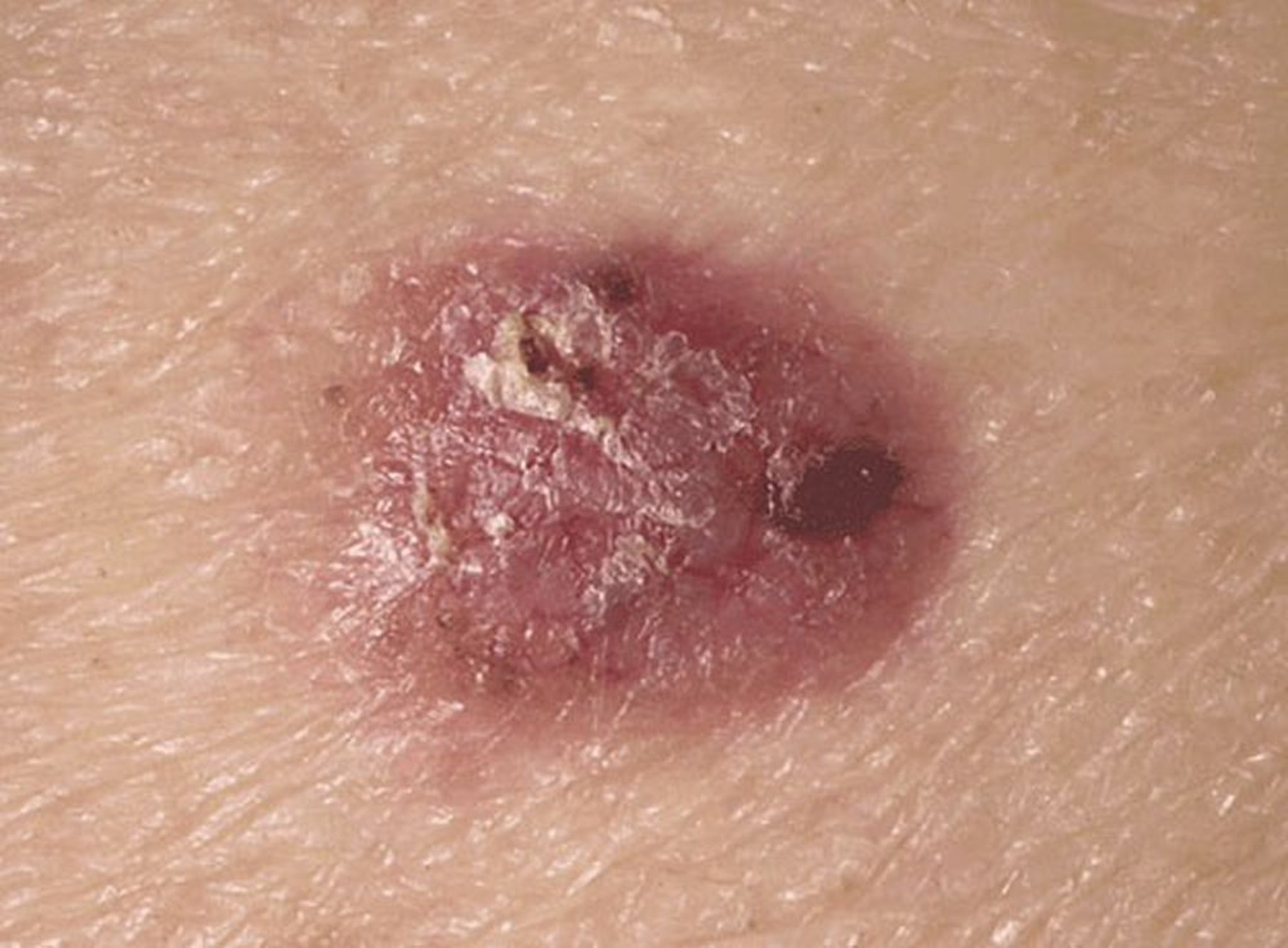 Carcinoma basocellulare nodulare (1)