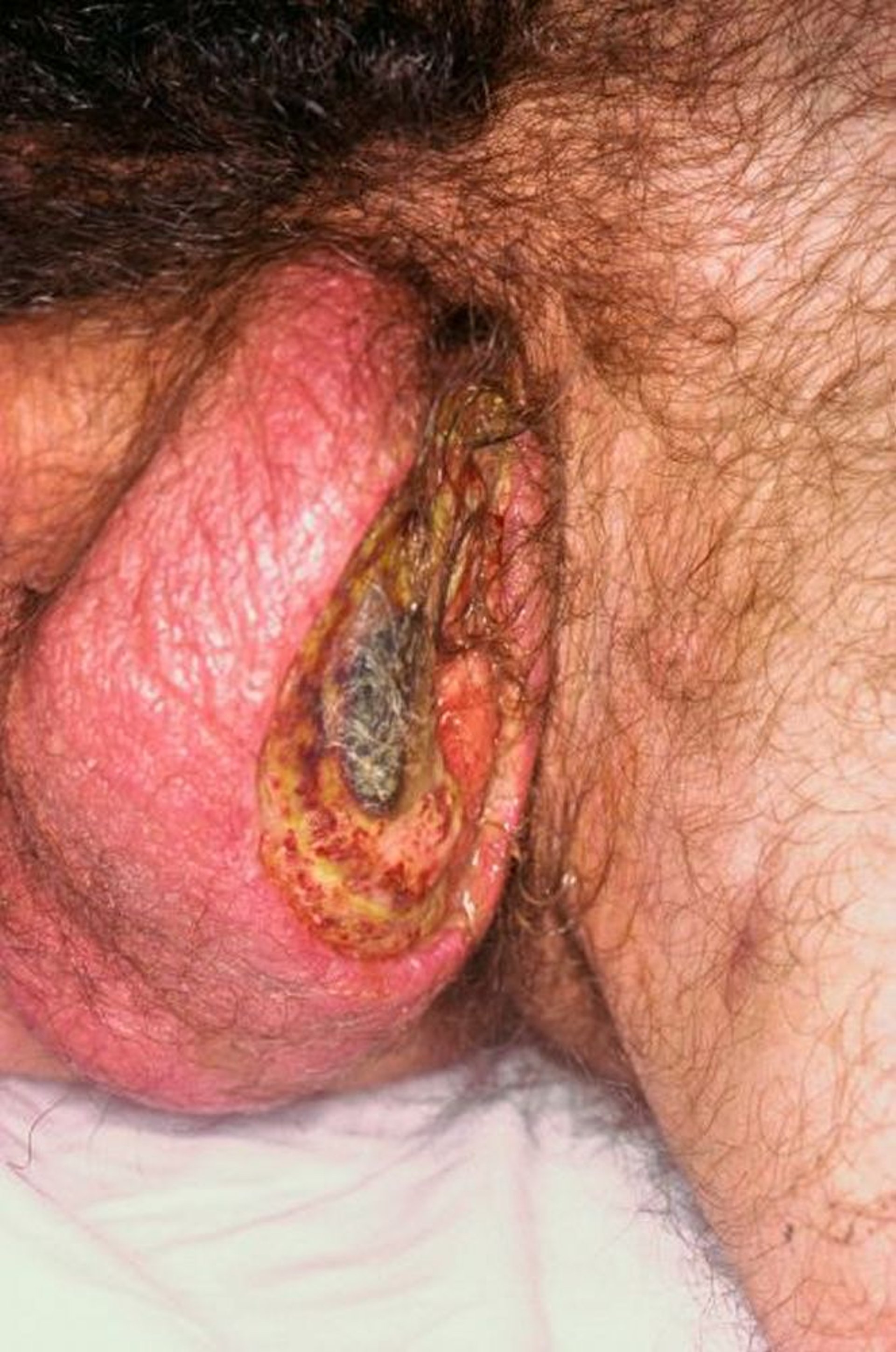 Behçet Disease (Scrotal)