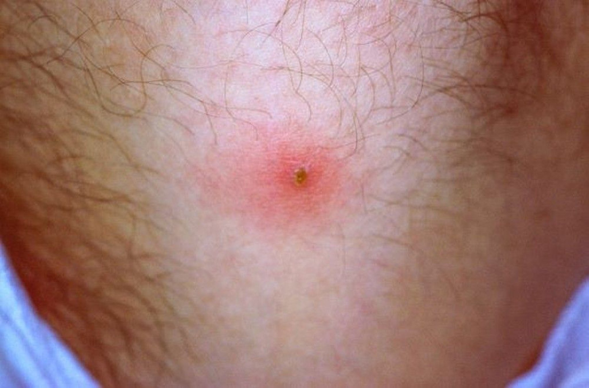 Behçet Disease (Pathergy)